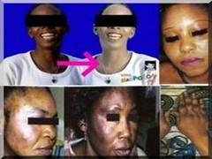 http://www.cridem.org/media/photos/photo/depigmentation_3.jpg